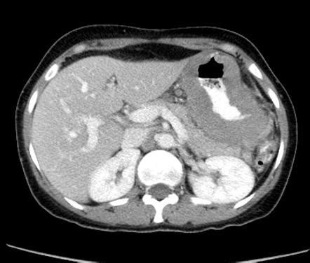 Gastric lymphoma | Image | Radiopaedia.org