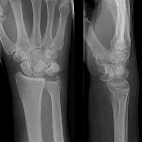 Splinter Series A Case Of Traumatic Wrist Pain After Fall On Outstret