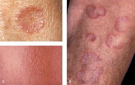 The Skin In Immune Autoimmune And Rheumatic Disorders Fitzpatricks
