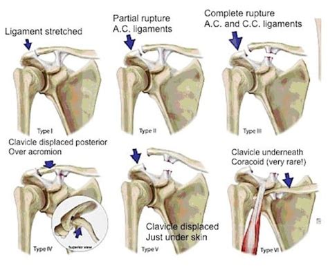 Ac Joint Separations Overview Of Diagnosis And Treatment