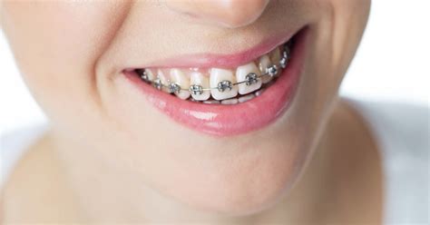 Traditional Metal Braces FUNtastic Dental Orthodontics