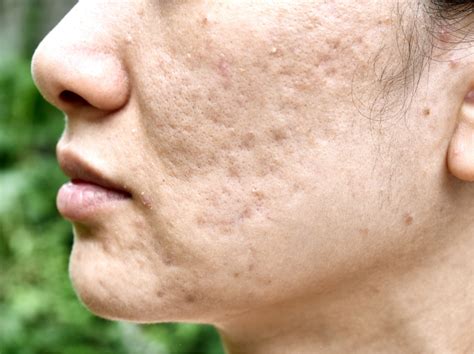 What Is Acne Scar And What Causes Acne Scar Curamed Aesthetics