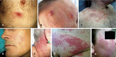 Follicular Mucinosis Associated With Nonlymphoid Skin Condit The