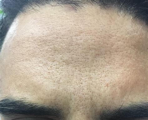 Skin Concerns Cant Tell If These Are Sebaceous Filaments Or Just