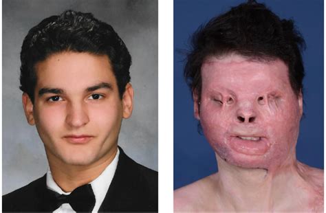 NYU Doctors Complete Successful Face And Hand Transplant Canada