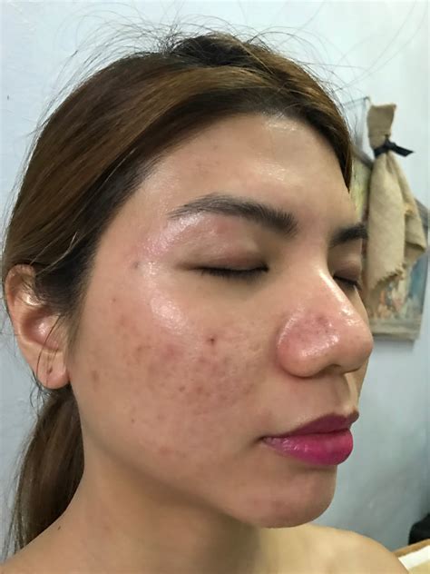 Последние твиты от cosmetic skin clinic (@cos_skinclinic). Q-Switched Laser and Shining Peel at Skin Gym Laser Clinic ...