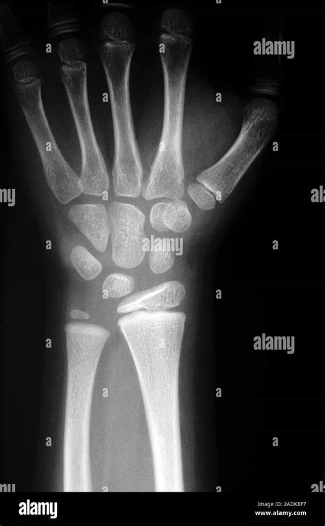 Los Huesos De La Muñeca Radiografía De Los Huesos De La Muñeca En Un
