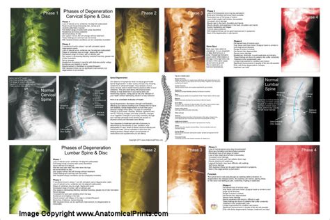 Phases Of Spinal Degeneration Poster 24 X 36