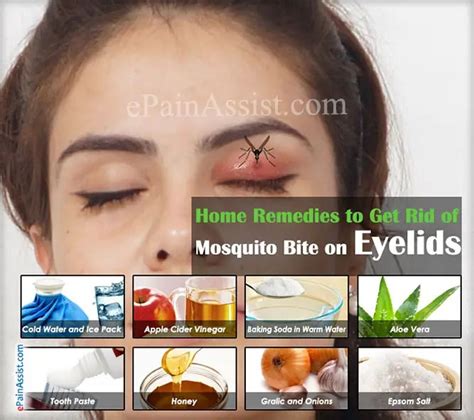Treatment For Mosquito Bite On Eyelid Chartdevelopment