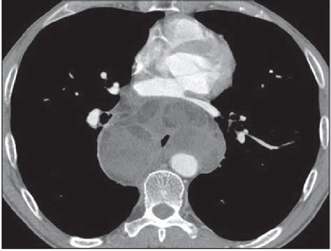 Contrast Enhanced Axial Ct Scan Showing A Large Lobulated Mass With