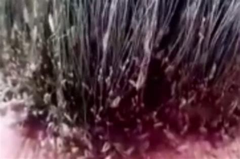 Worst head lice video EVER: Man calls NIT ASSASSIN after millions