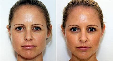 What Is Masseter Botox The Daily Glimmer