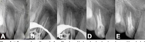 Figure From Non Surgical Root Canal Treatment Of Dens Invaginatus