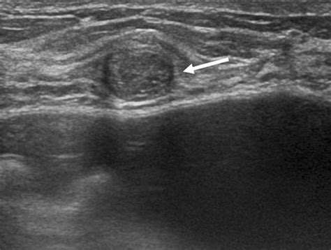 A 50 Year Old Woman With Fibroadenoma Breast Ultrasound Shows An Oval