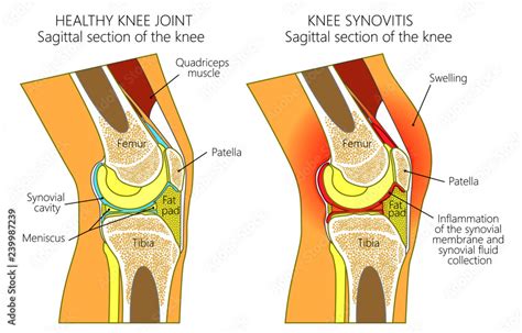 Mri Knee Cross Sectional Anatomy Sagittal Image Knee Mri Knee The