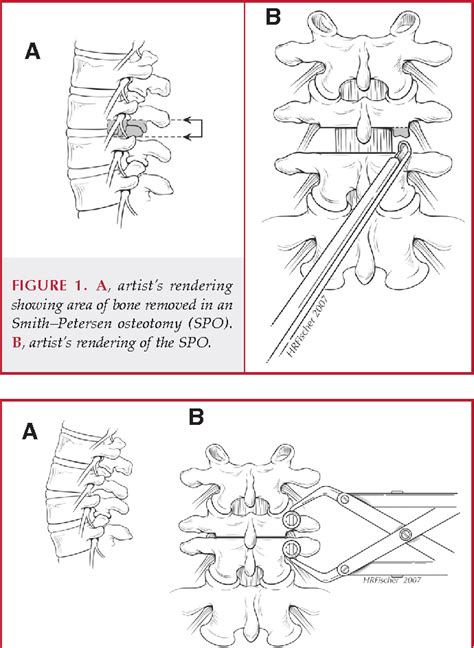 Figure 1 From Smithpetersen Osteotomy In Thoracolumbar Deformity