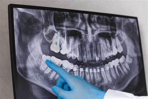 Signs And Symptoms Of Wisdom Tooth Eruption Dental Implants And Ph
