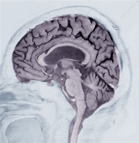 Alzheimers Disease Mri Brain Scan Stock Image C0388638 Science