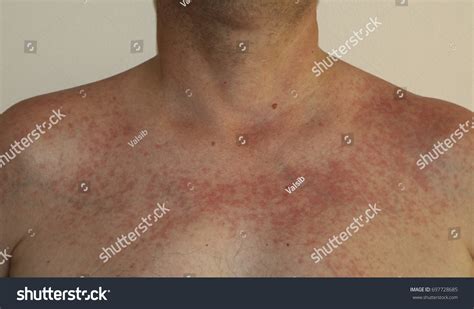 213 Radiation Dermatitis Images Stock Photos 3d Objects And Vectors