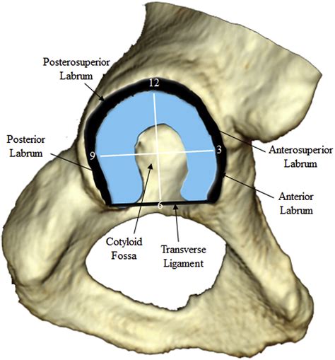 Acetabular Labral Tear Description And Measures Of Pincer And Cam Type