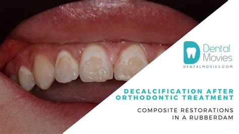 Decalcification After Orthodontic Treatment Composite Restorations In