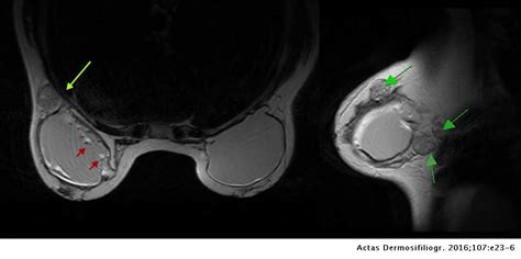 Axillary Silicone Granulomas In Patients With Melanoma Actas Dermo