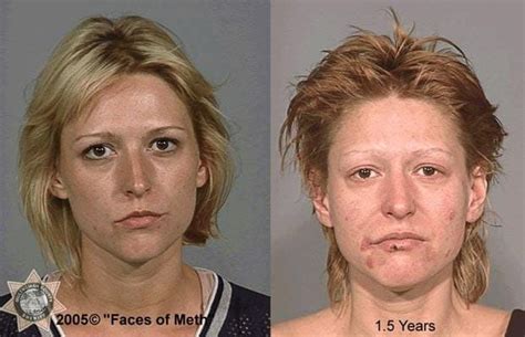 Faces Of Meth The Long Term Effects Of Crystal Meth Or Methamphetamine