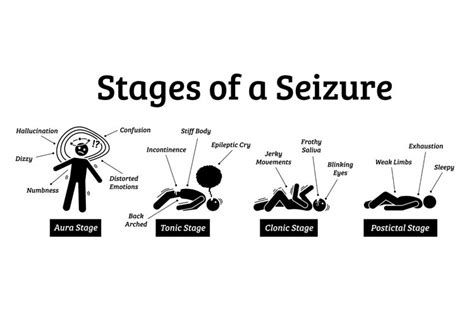 Stages And Phases Of A Seizure Aura Tonic Clonic Postictal