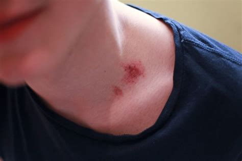 How To Get Rid Of A Hickey Tested Remedies Online Health Media