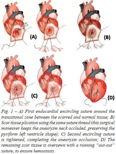 Braz J Cardiovasc Surg A Variant Technique For The Surgical Treatment
