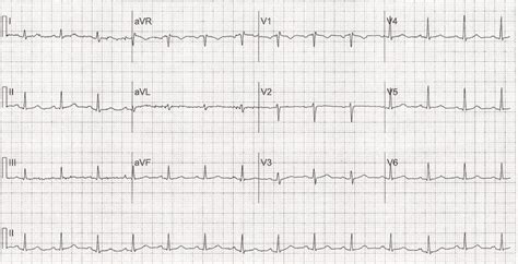 12 Lead Electrocardiogram Shows A Normal Sinus Rhythm At 82 Beats Per