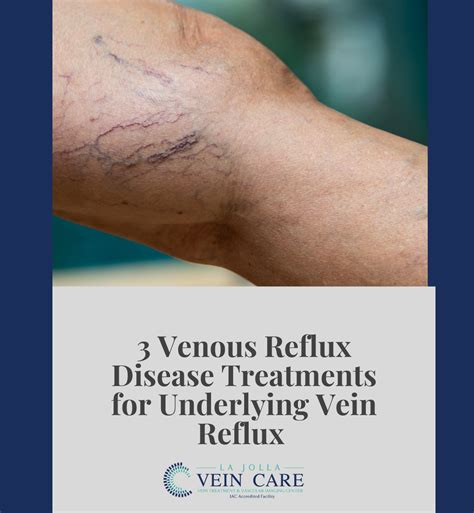 3 Venous Reflux Disease Treatments For Underlying Vein Reflux