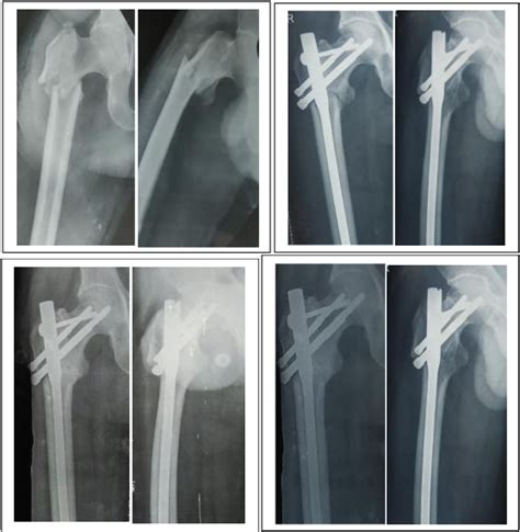 Figure 3 From Efficacy Of Proximal Femoral Nail Augmentation In