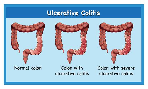 What Is Ulcerative Colitis Symptoms Causes Diagnosis I U