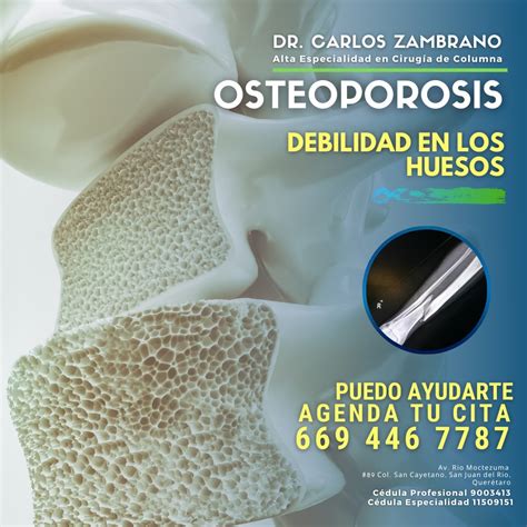 La Osteoporosis Es Una Enfermedad Que Adelgaza Y Debilita Los Huesos