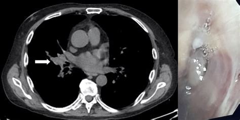 Successful Resection Of An Endobronchial Pleomorphic Adenoma Using