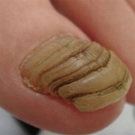 変形爪投稿 - 神戸の巻き爪治療専門店｜神戸足の治療院