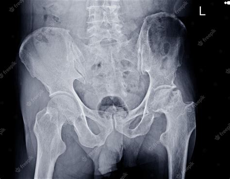 radiografía de película tanto las caderas como la pelvis muestran aplanamiento y cambio quístico