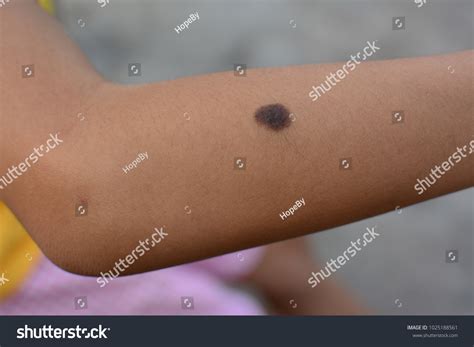 Mole Birthmark On Skin Hand Can ภาพสต็อก 1025188561 Shutterstock