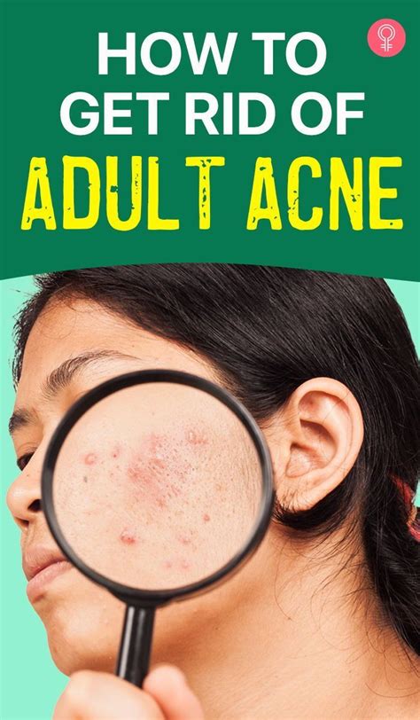 How To Get Rid Of Adult Acne Artofit