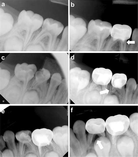 Periapical Radiographs Showing Successful And Failed Mta Pulpotomy A