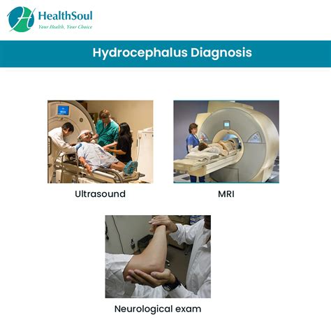 Hydrocephalus Symptoms Diagnosis And Treatment Healthsoul