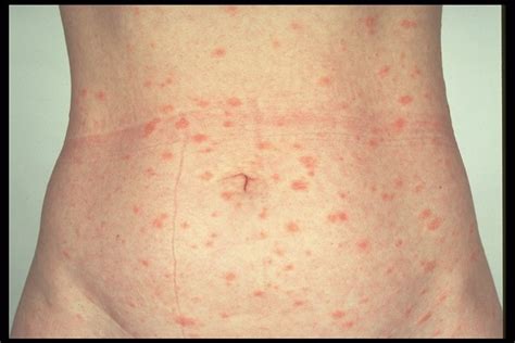Pityriasis Rosea Pictures Causes Diagnosis Treatment And Home