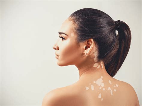 How Does Vitiligo Start And What Are The Symptoms Ask Skin Expert