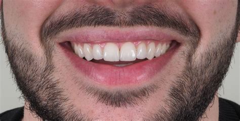 We would like to show you a description here but the site won't allow us. Facetas Dentárias • Clínica Marisa Zenha