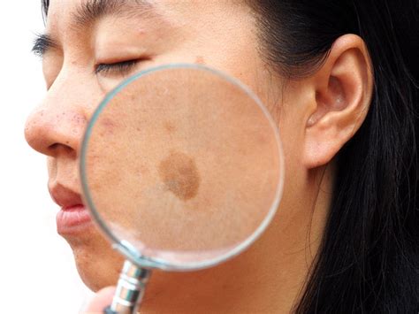 5 Different Types Of Skin Blemishes On The Face And Its Treatments
