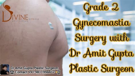 Grade Gynecomastia Surgery With Dr Amit Gupta Plastic Surgeon YouTube