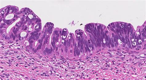 Adenocarcinoma In Situ Of The Cervix Atlas Of Pathology