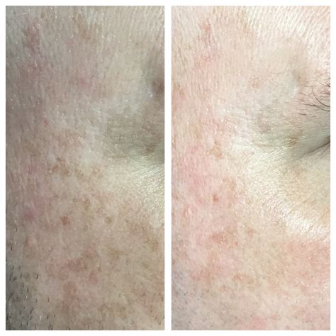 Microneedling For Acne Scars Dr Novikov Wellness And Skin Care
