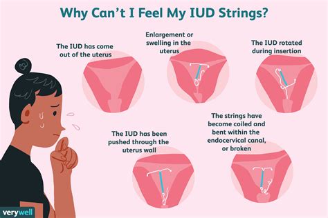 Iud Strings What To Do If Theyre Missing